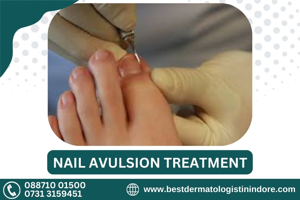 Best Nail Avulsion Specialist in Indore